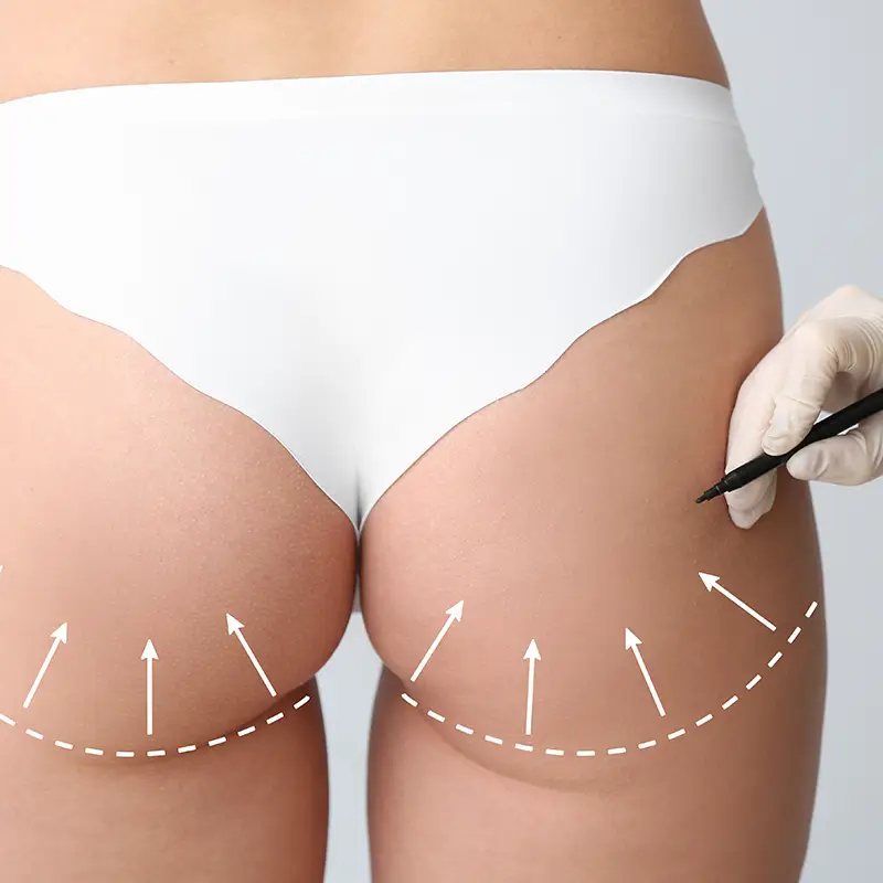 Brazilian Butt Lift