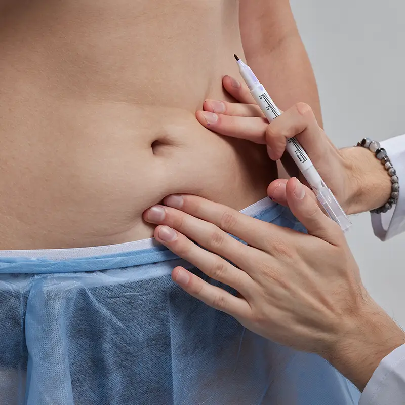 Abdominoplastie
