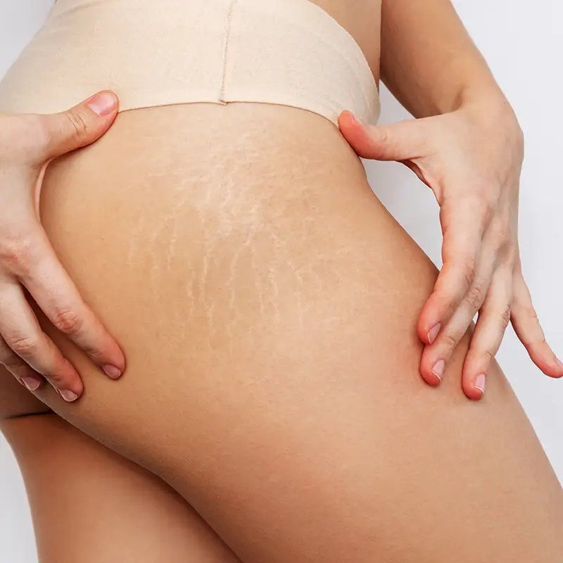 Traitement des vergetures et de la cellulite